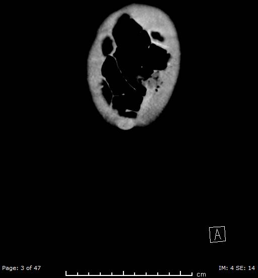 File:Neuroblastoma (Radiopaedia 41472-44355 B 3).jpg