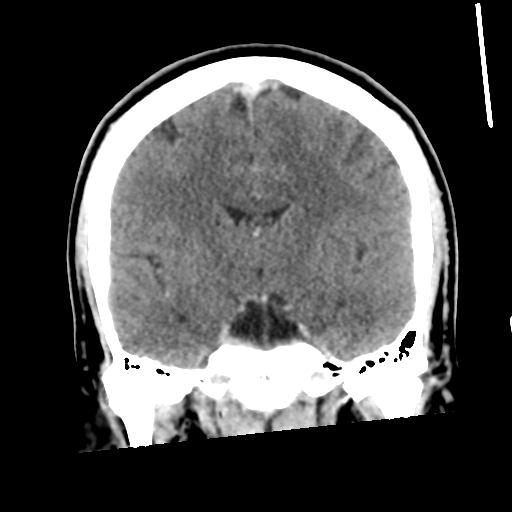 Neurocysticercosis - granular nodular (Radiopaedia 42786-45957 Coronal C+ 33).png