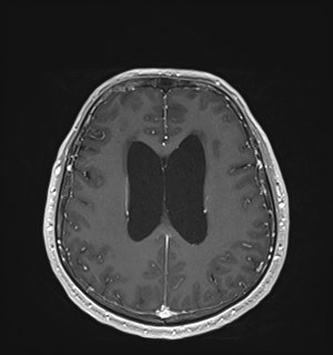 Neurofibromatosis type 2 (Radiopaedia 79097-92049 Axial T1 C+ 130).jpg