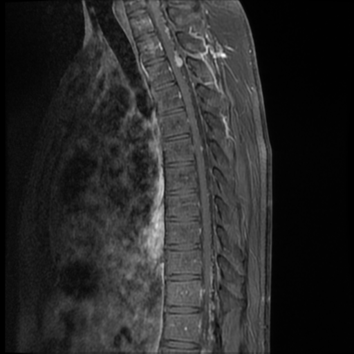 File:Neurofibromatosis type 2 (spinal manifestations) (Radiopaedia 53943-60070 I 7).png