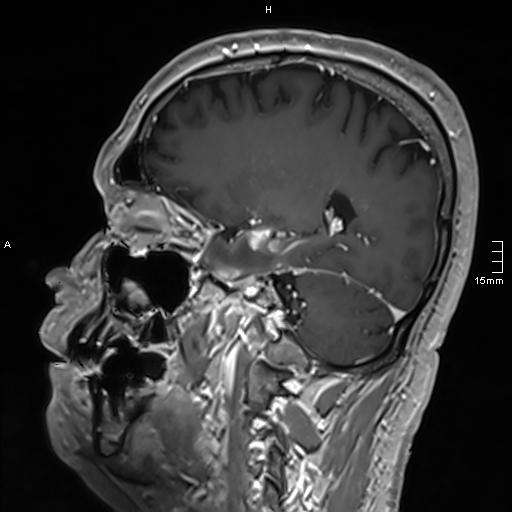 Neurosarcoidosis - involvement of the mesial temporal lobes (Radiopaedia 67429-76820 Sagittal T1 C+ 62).jpg