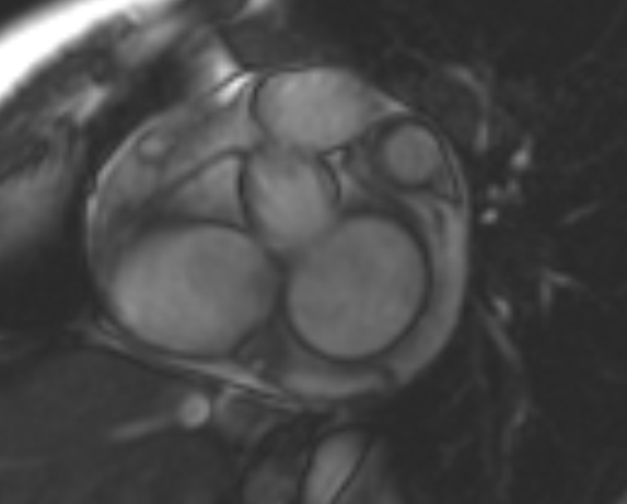 File:Non-compaction of the left ventricle (Radiopaedia 69436-79314 Short axis cine 204).jpg