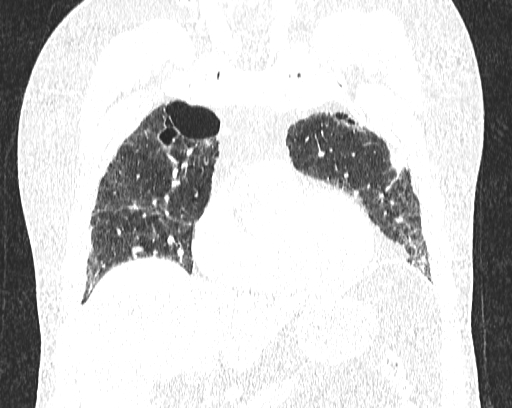 Non-specific interstitial pneumonia (NSIP) (Radiopaedia 68599-78228 Coronal lung window 26).jpg