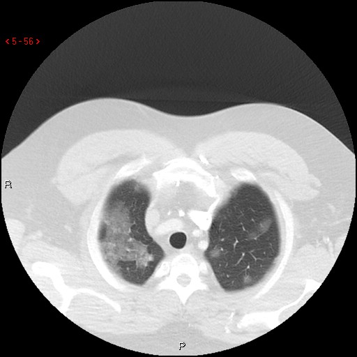 File:Non-specific interstitial pneumonitis (Radiopaedia 27044-27222 Axial lung window 47).jpg