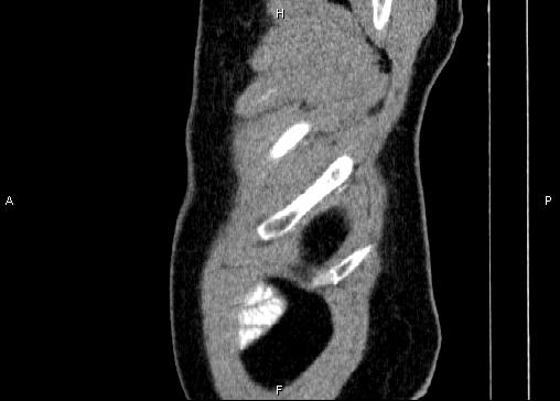 Non-syndromic pancreatic endocrine tumor (Radiopaedia 86958-103178 E 3).jpg