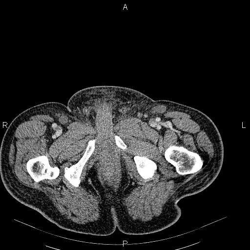 File:Non Hodgkin lymphoma in a patient with ankylosing spondylitis (Radiopaedia 84323-99621 B 68).jpg