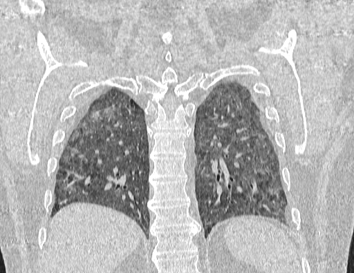 Non specific interstitial pneumonia (NSIP) (Radiopaedia 89725-106798 Coronal lung window 58).jpg