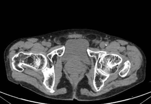 File:Nondisplaced incomplete intertrochanteric fracture (Radiopaedia 73736-84539 Axial soft tissue 63).jpg