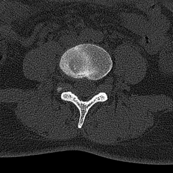 File:Normal CT lumbar spine (Radiopaedia 53981-60118 Axial bone window 50).jpg