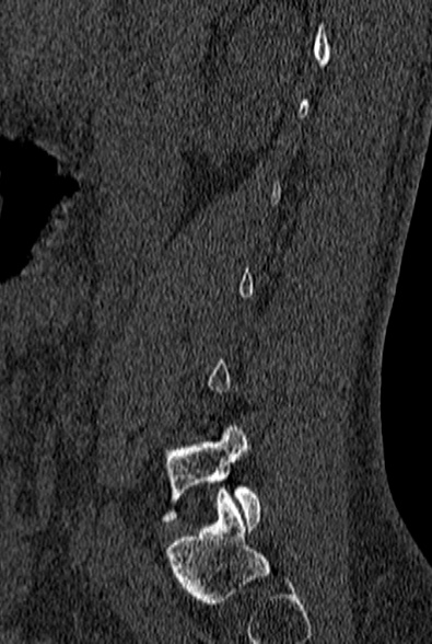 File:Normal CT lumbar spine (Radiopaedia 53981-60118 Sagittal bone window 19).jpg