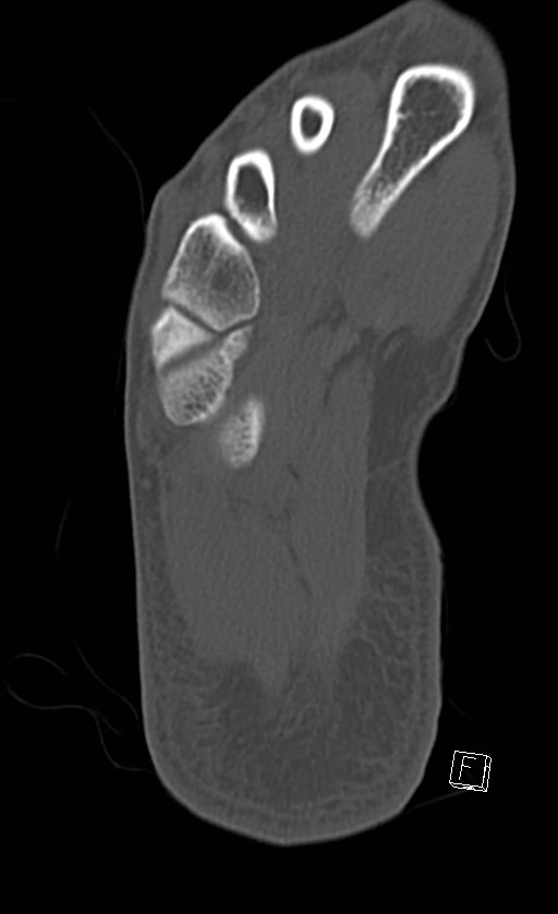 Normal CT of the ankle (Radiopaedia 47111-51658 Axial bone window 88).jpg