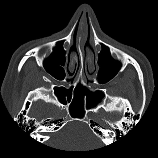 Normal CT paranasal sinuses (Radiopaedia 42286-45390 Axial bone window 65).jpg