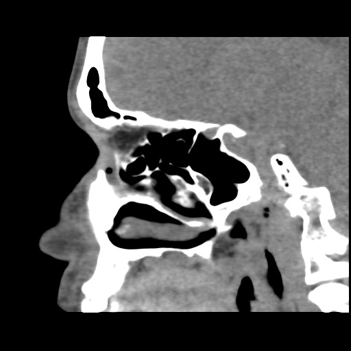 Normal CT paranasal sinuses (Radiopaedia 42286-45390 F 64).jpg