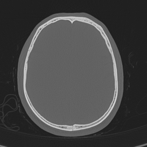 Normal CT skull (Radiopaedia 40798-43459 A 106).png