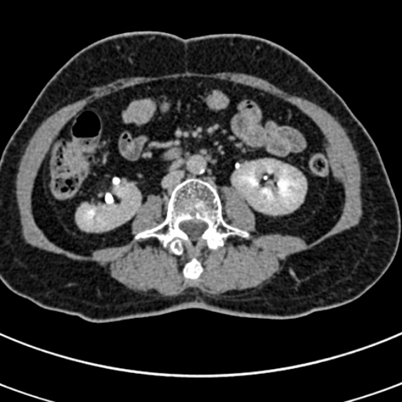 File:Normal CT split bolus study of the renal tract (Radiopaedia 48631-53634 Axial split bolus 126).jpg