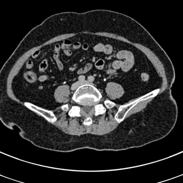 File:Normal CT split bolus study of the renal tract (Radiopaedia 48631-53634 Axial split bolus 178).jpg