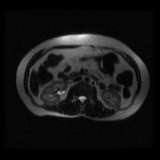 File:Normal MRCP (Radiopaedia 41966-44978 Axial T2 thins 6).png