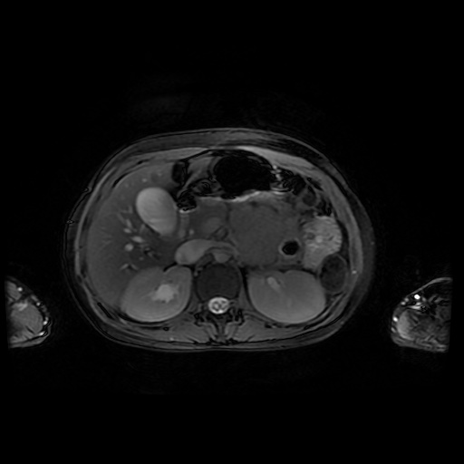File:Normal MRI abdomen in pregnancy (Radiopaedia 88001-104541 D 17).jpg