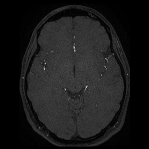 Normal brain MRA (Radiopaedia 41046-43793 Axial MRA 36).png