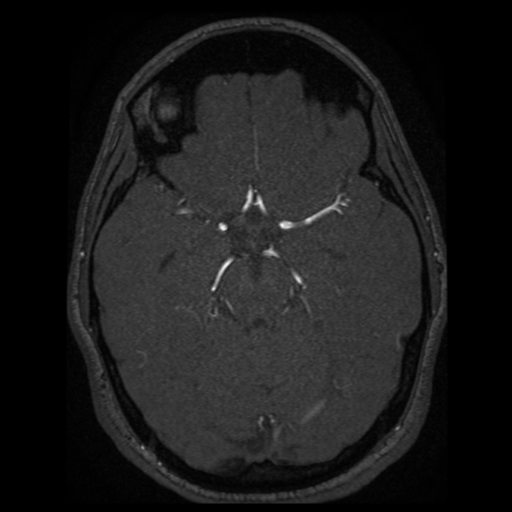 Normal brain MRA (Radiopaedia 41046-43793 Axial MRA 54).png