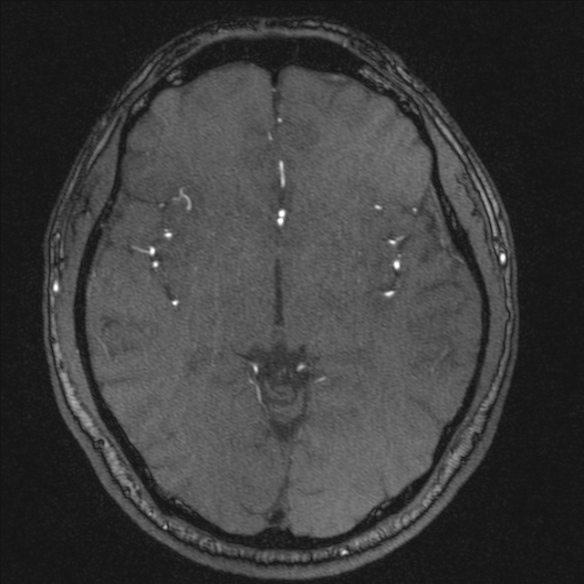 Normal brain MRI including MRA (Radiopaedia 48748-53763 Axial MRA 104).jpg