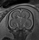 Normal brain fetal MRI - 22 weeks (Radiopaedia 50623-56050 Coronal T2 Haste 12).jpg