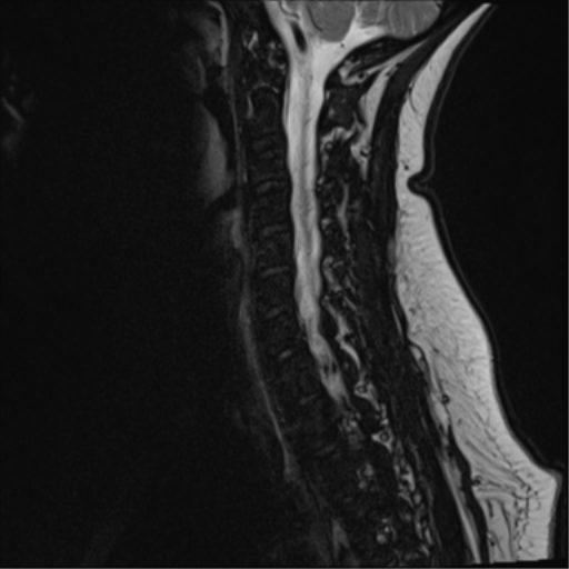 File:Normal cervical spine MRI (including Dixon) (Radiopaedia 42762-45925 Dixon- opposed phase 6).png