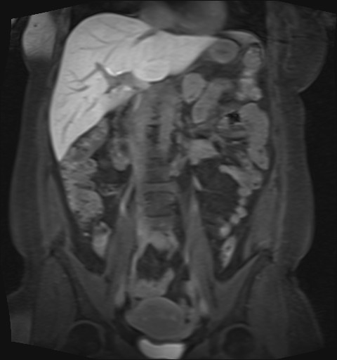 File:Normal hepatobiliary phase liver MRI (Radiopaedia 58968-66230 B 28).jpg