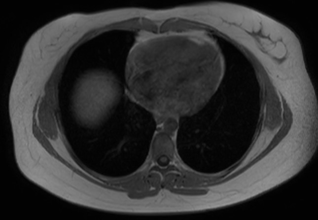 File:Normal liver MRI with Gadolinium (Radiopaedia 58913-66163 Axial T1 in-phase 32).jpg