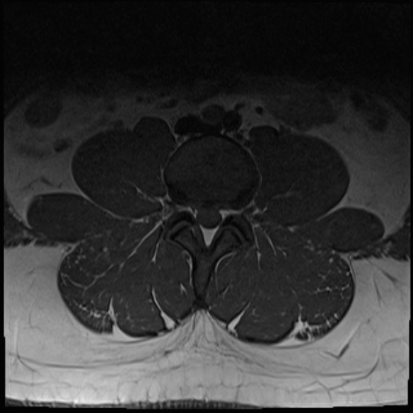 File:Normal lumbar spine MRI (Radiopaedia 47857-52609 Axial T1 9).jpg