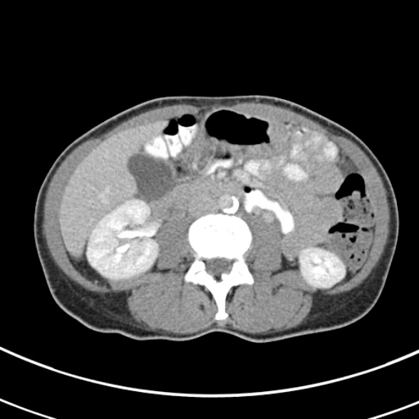 File:Normal multiphase CT liver (Radiopaedia 38026-39996 C 43).jpg