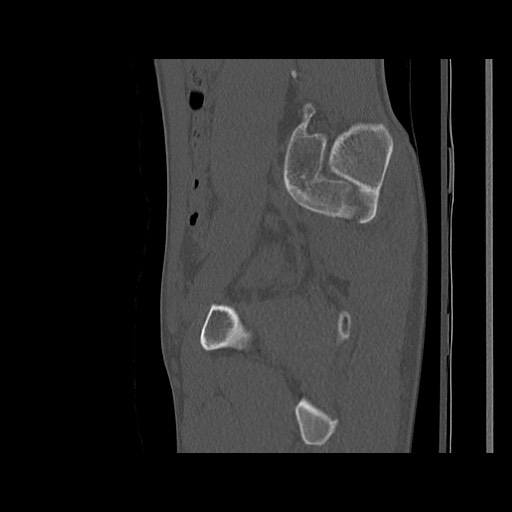 Normal pelvis (Radiopaedia 51473-57238 Sagittal bone window 99).jpg