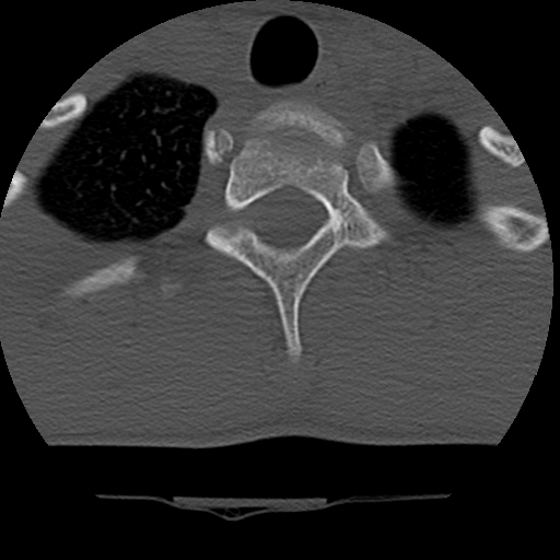 Normal trauma spine imaging (age 16) (Radiopaedia 45335-49358 Axial bone window 79).jpg