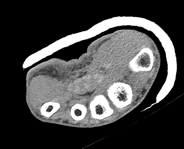 Normal wrist CT (Radiopaedia 41425-44297 Axial non-contrast 19).png