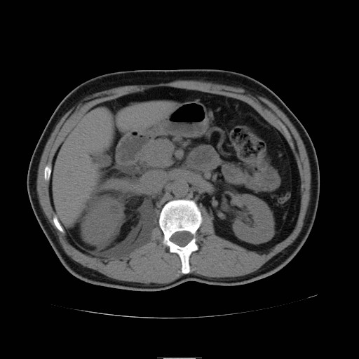 File:Obstructed kidney with perinephric urinoma (Radiopaedia 26889-27066 Axial non-contrast 16).jpg