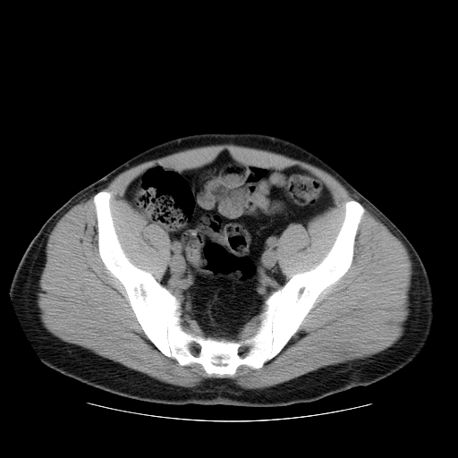 File:Obstructing ureteric calculus (Radiopaedia 18615-18514 Axial non-contrast 45).jpg