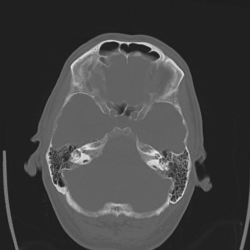 File:Obstructive hydrocephalus (Radiopaedia 30453-31119 Axial bone window 24).jpg