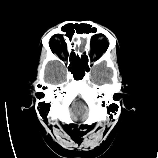 File:Obstructive hydrocephalus (Radiopaedia 30453-31119 Axial non-contrast 4).jpg