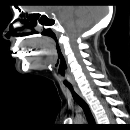 File:Obstructive sleep apnea (CT evaluation) (Radiopaedia 24304-24582 C 37).jpg