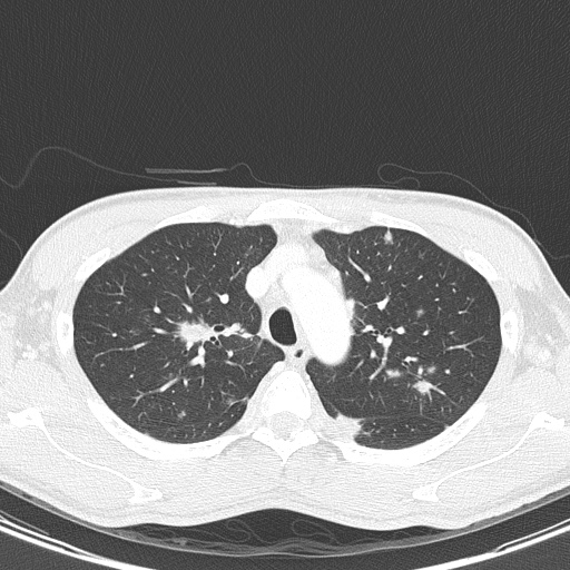 AIDS-related Kaposi sarcoma (Radiopaedia 85247-100811 Axial lung window 43).jpg