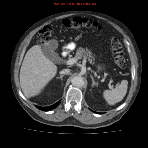 File:Abdominal aortic aneurysm (Radiopaedia 10122-10660 Axial C+ portal venous phase 21).jpg
