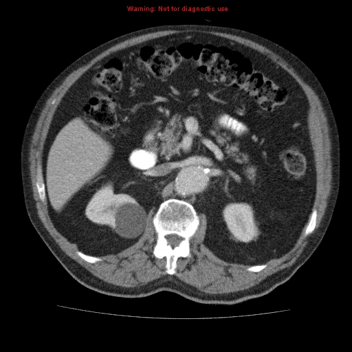 Abdominal aortic aneurysm (Radiopaedia 10122-10660 Axial C+ portal venous phase 26).jpg