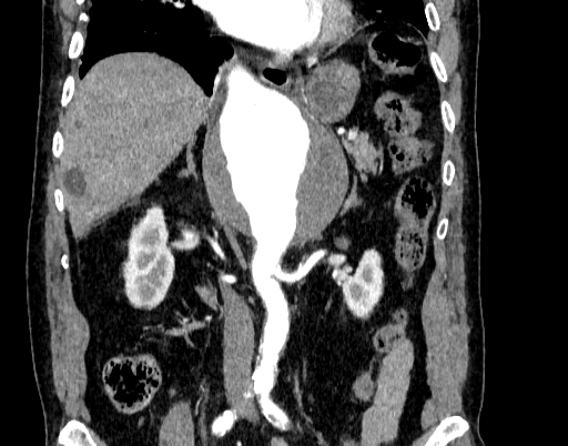 File:Abdominal aortic aneurysm (Radiopaedia 67117-76452 Coronal C+ arterial phase 50).jpg