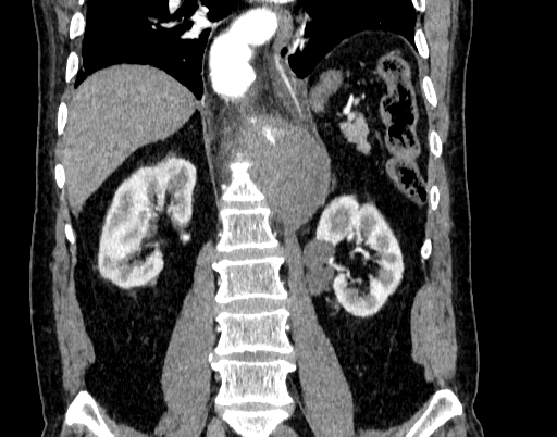 Abdominal aortic aneurysm (Radiopaedia 67117-76452 Coronal C+ arterial phase 66).jpg