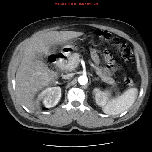 Abdominal aortic aneurysm (Radiopaedia 8190-9038 Axial C+ arterial phase 27).jpg