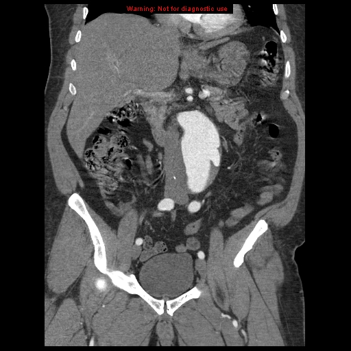 Abdominal aortic aneurysm (Radiopaedia 8190-9038 Coronal C+ arterial phase 58).jpg