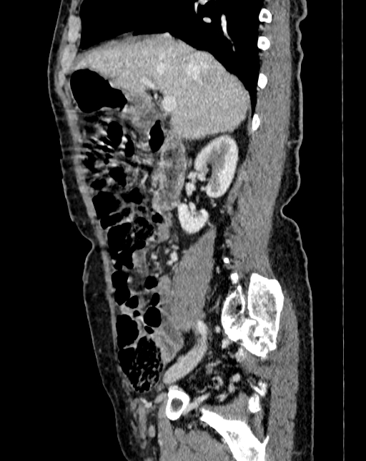 Abdominal aortic aneurysm (Radiopaedia 83581-98689 Sagittal C+ portal venous phase 13).jpg