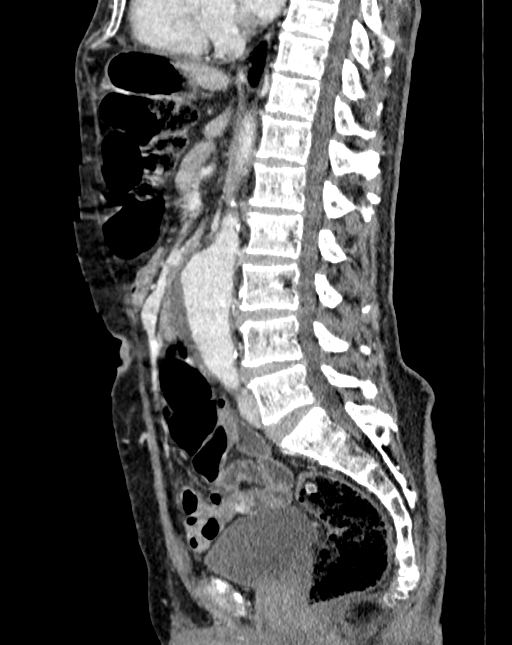 Abdominal aortic aneurysm (Radiopaedia 83581-98689 Sagittal C+ portal venous phase 51).jpg