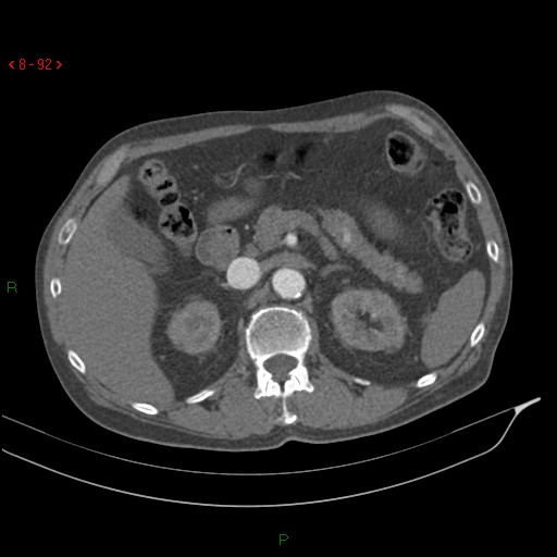 Abdominal aortic aneurysm rupture with aortocaval fistula (Radiopaedia 14897-14841 Axial C+ arterial phase 92).jpg
