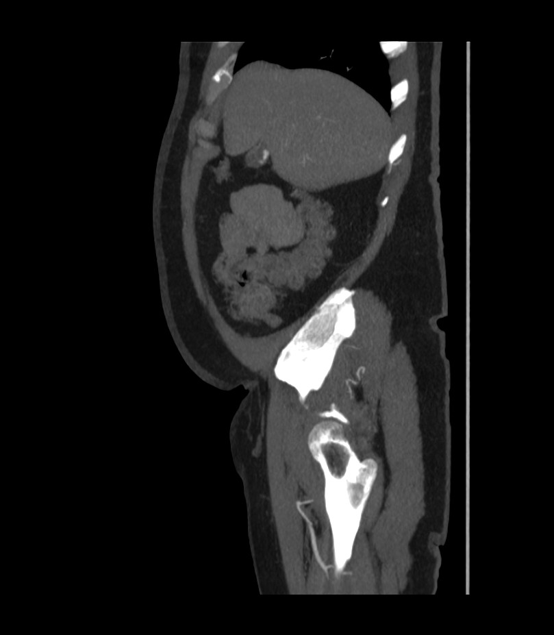 Abdominal aortic aneurysm with thrombus fissuration (Radiopaedia 46218-50618 Sagittal C+ arterial phase 9).jpg